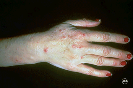 Rash caused by fiberglass - Contact Dermatitis
