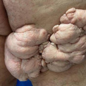Card image for nevus lipomatosus superficialis. 