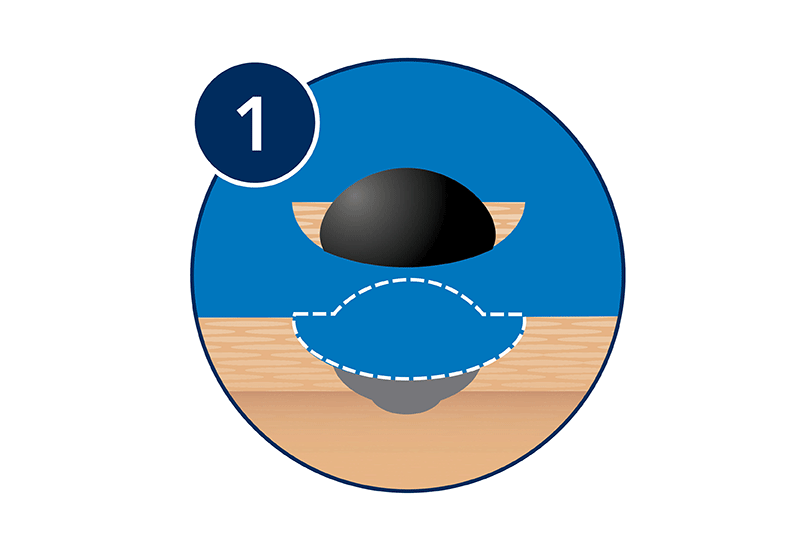 Mohs surgery: The visible tumor and a thin layer of surrounding skin are removed.