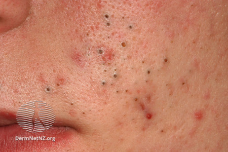 blackheads on face