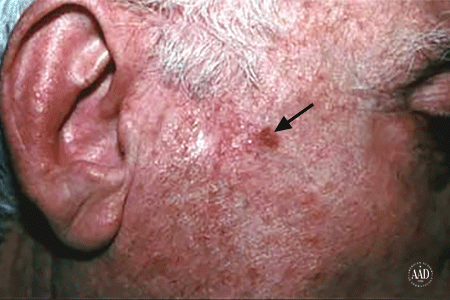 An age spot on the side of a man's face could be squamous cell carcinoma