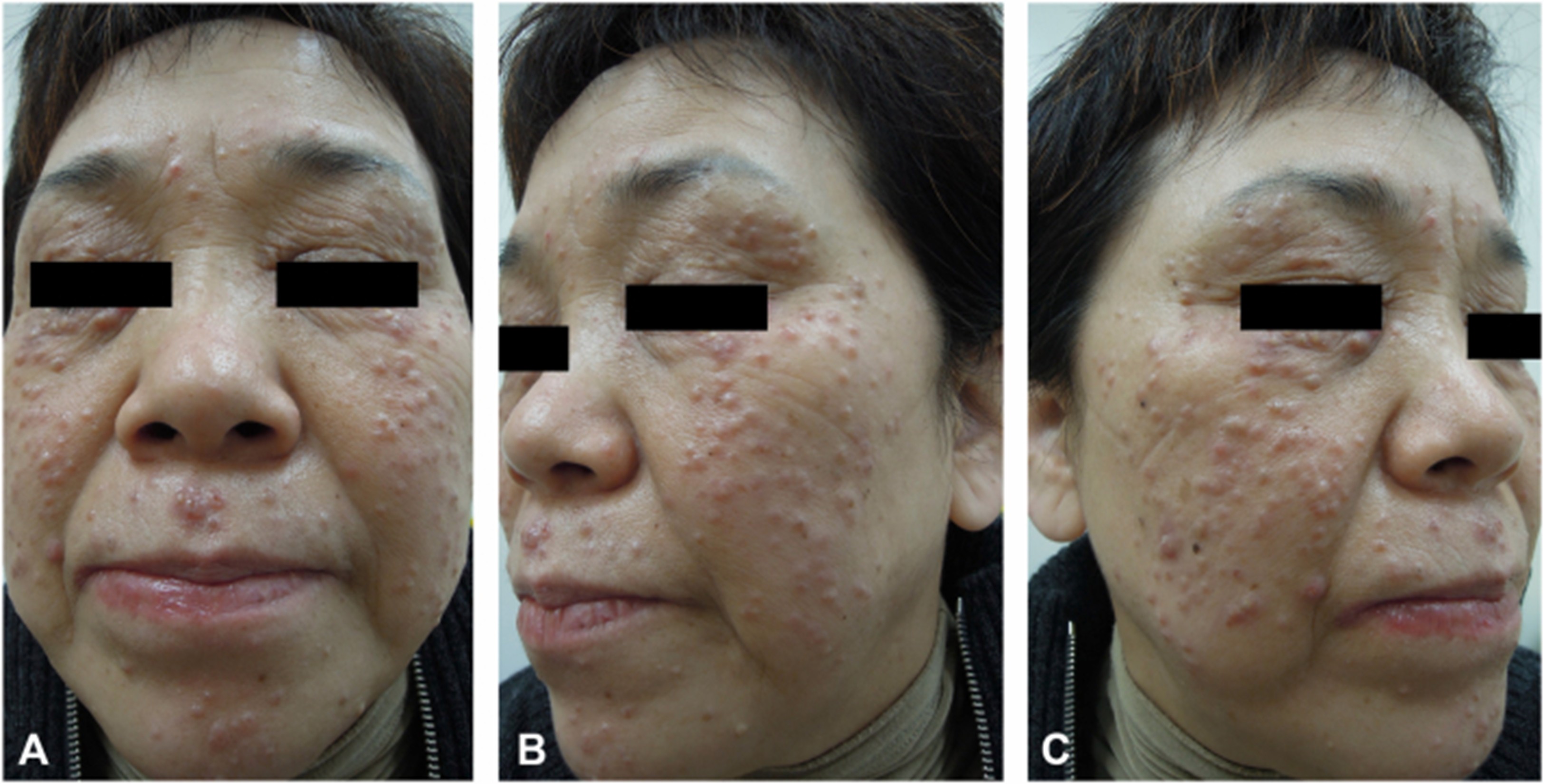 Image of an Asian female patient who shows signs of lupus miliaris disseminatus faciei.