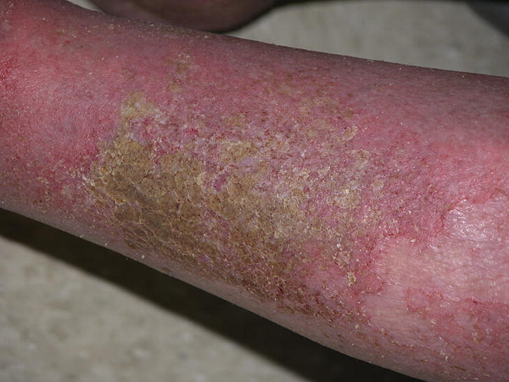 Image of venous eczema for DWII from JAAD 2012; 67(2): 177