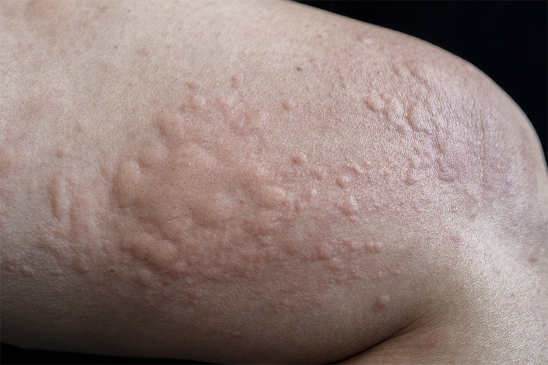 urticaria