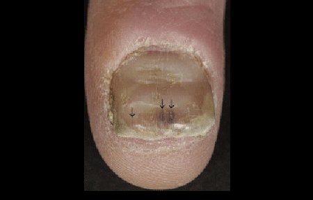 nail crumbling psoriasis