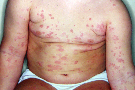 Baby with widespread hives.