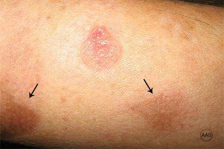 Bullous pemphigoid blisters - Stock Image - C055/9327 - Science