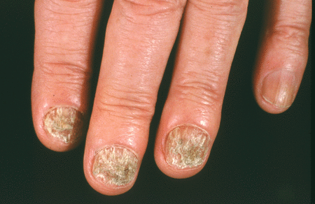 Nail fungus has spread and damanged several nails on the hand