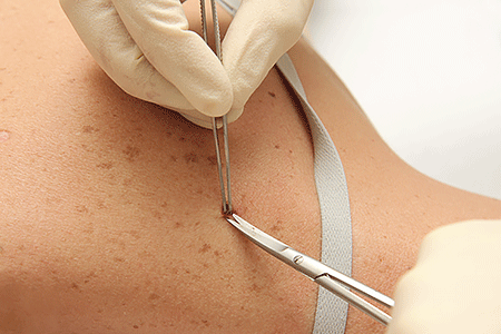 Dermatologist removing basal cell carcinoma skin cancer