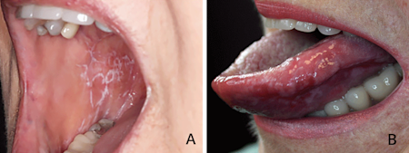 Lacy pattern on the inside of the mouth due to lichen planus (A), Oral lichen planus causing white bumps on tongue (B)