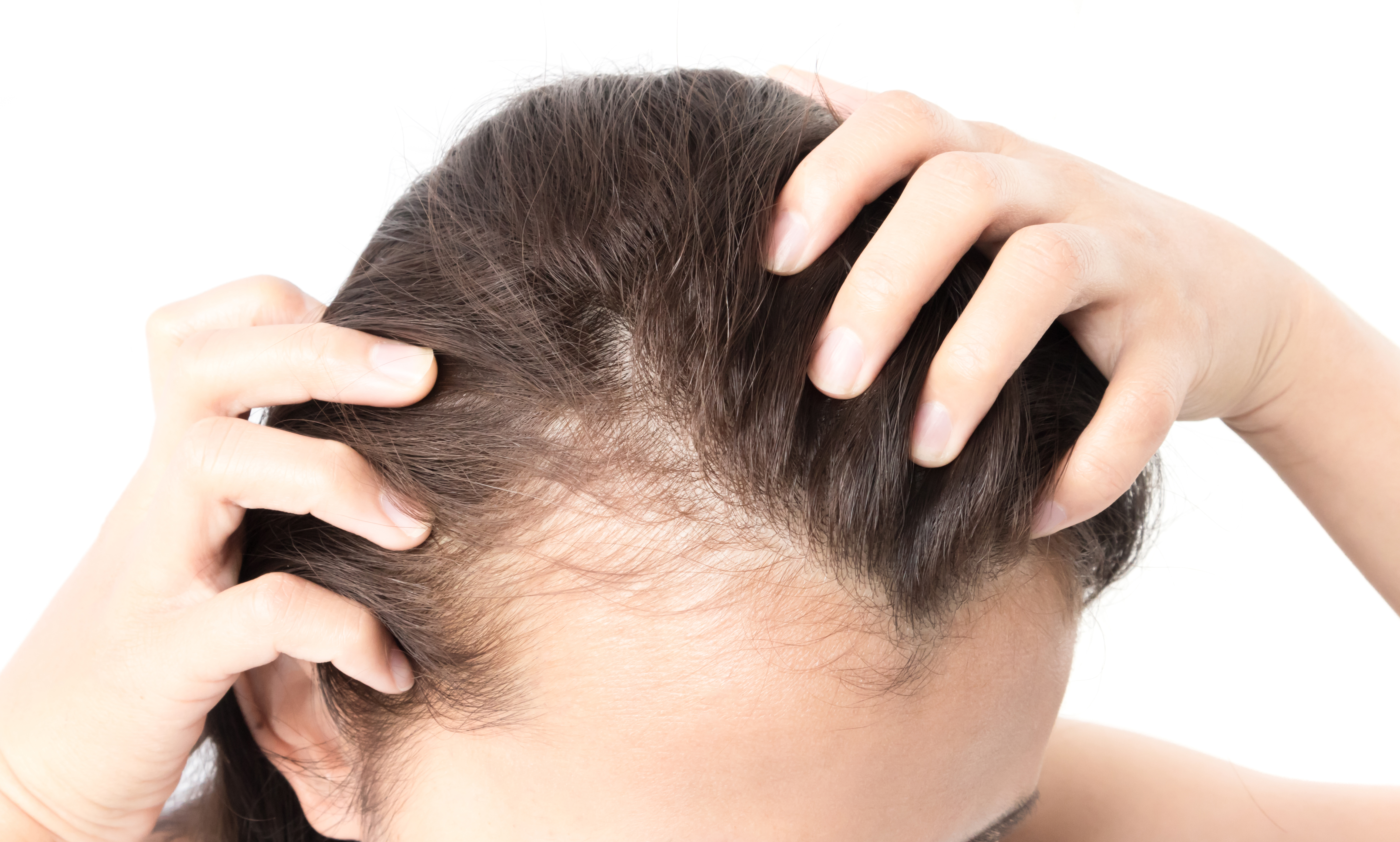 Hair loss Who gets and causes