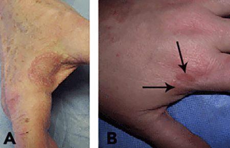 Localized granuloma annulare on skin