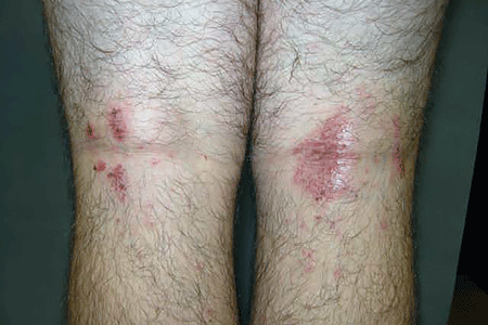 Reddish bumps of nummular eczema on back of knees