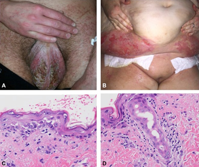 Illustration for DWII on toxic erythema of chemotherapy
