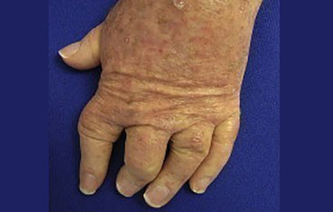 Psoriatic Arthritis: Symptoms