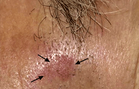 Actinic Keratosis Signs And Symptoms Actinic Keratosis Signs And Symptoms