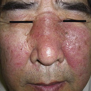 Face with reddened cheeks to show signs of eosinophilic pustular folliculitis.