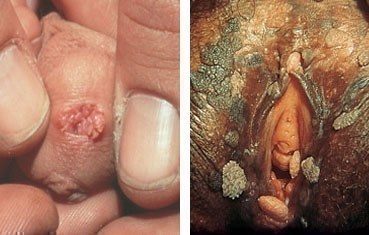 Genital warts appear in various sizes