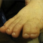 Close-up of a child’s bare foot showing the toes and toenails, resting against a dark background.