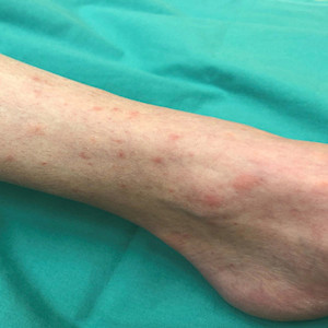 Card image for DWII of cystic fibrosis sign on the skin