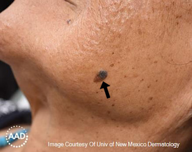 Melanoma is a type of skin cancer that can look like a new or changing mole.