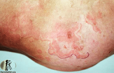 Erythema marginatum red rash