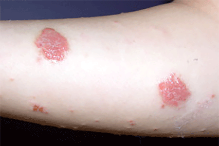 Coin-shaped raised spots of nummular eczema on arm