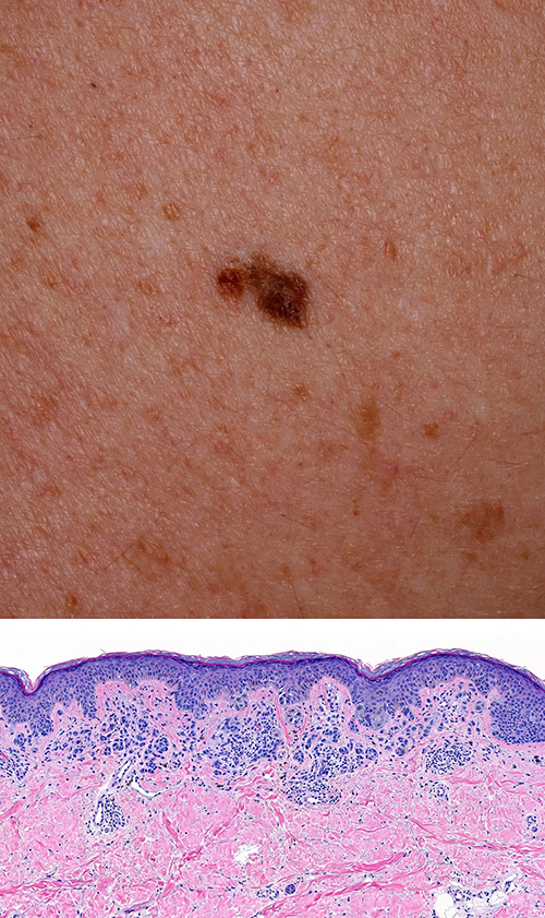 Clinical and histopathologic images for DWII of a high grade melanocytic nevus