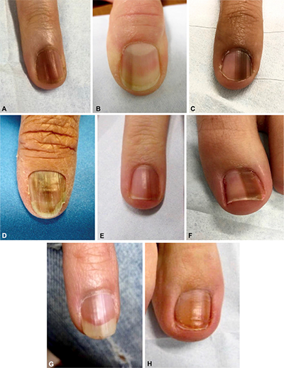 Illustration of nails for DWII on nail unit melanomas