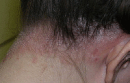 mild scalp psoriasis pictures