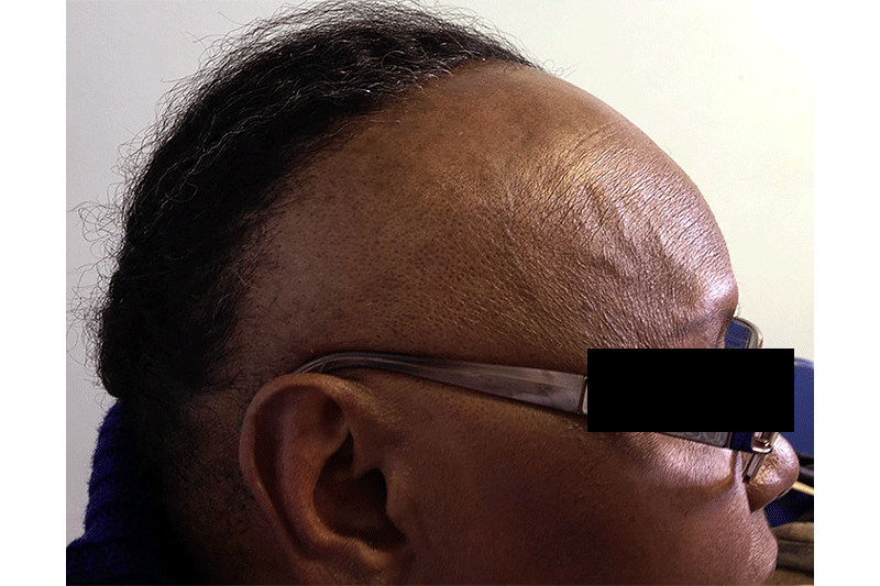 Hair loss types Frontal fibrosing alopecia signs and symptoms