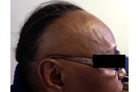 Hairline has receded, leaving most of scalp bald