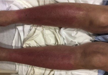 Image of skin signs of eosinophilic fasciitis 