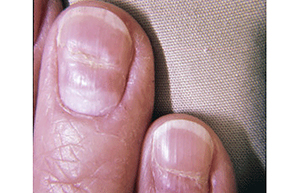 Fingernail Health Chart