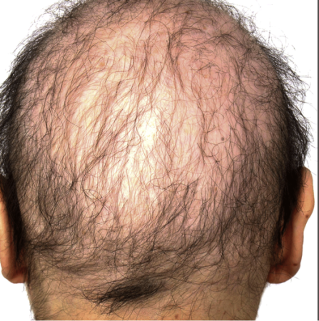 Hair loss types: Alopecia areata signs and symptoms