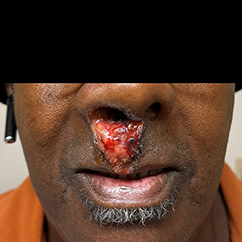 Patient with lesion extending from nose to lip as cutaneous manifestation of cocaine use.