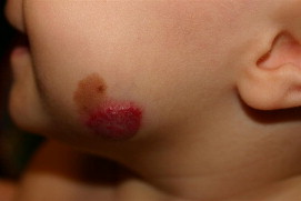Image for DWII on infantile hemangiomas