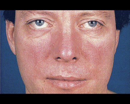 Is rosacea causing your red, irritated face?