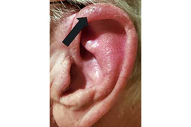 Scaly reddish area at the curved top of this patient’s ear is basal cell carcinoma | American Academy of Dermatology