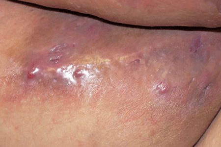 Inner thighs - deep scarring from ingrown hair cysts, stretch