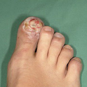 Cannabis arteritis for DermWorld Insights and Inquiries | American Academy of Dermatology (AAD).