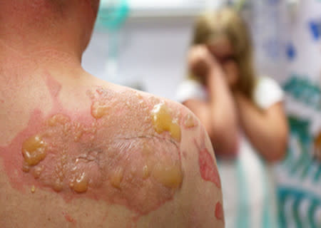 Third degree burn on back and shoulder of a man