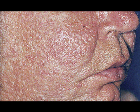 person with rosacea on face