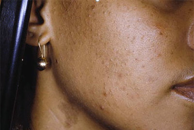 A woman of color's acne