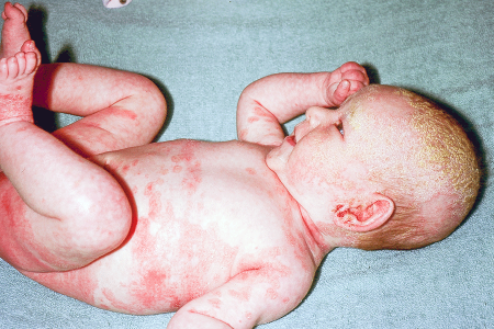 Baby with cradle cap on his scalp, body folds, and diaper area