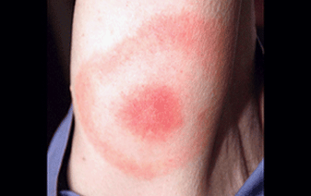 Signs of Lyme disease that appear on your skin