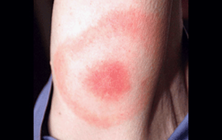 Bull's-eye rash from Lyme disease on woman's upper arm