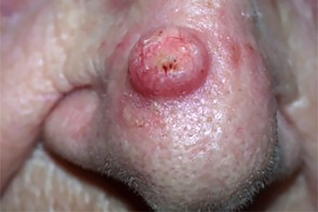 Raised red growth is squamous cell skin cancer