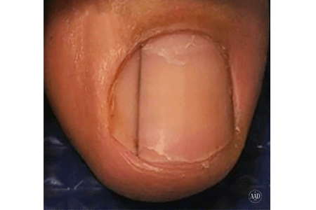 The dark line beneath this fingernail could be melanoma