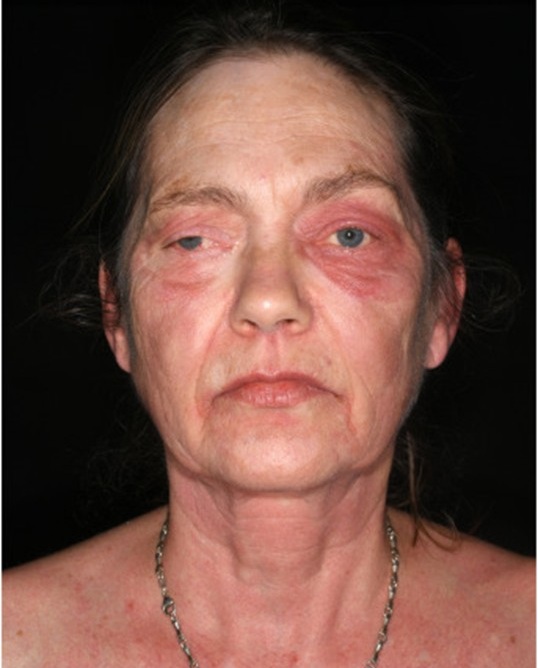 Image of woman with reddened skin around her eyes, from side effects for treatment of uveal melanoma